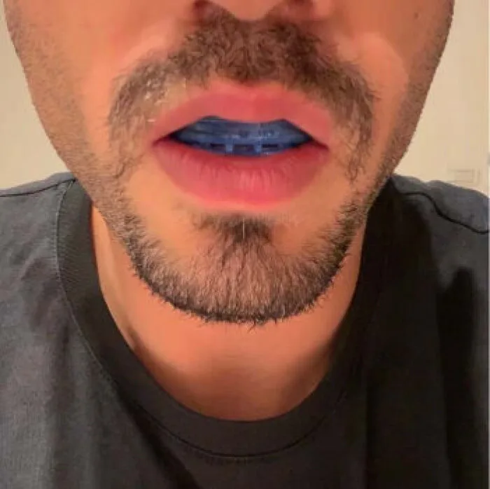 SleepZee mouthpiece being worn