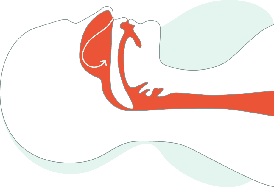 Diagram showing how SnoreRX opens the airway by advancing the jaw forward